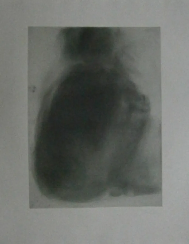 Radierung Garache - Tourette